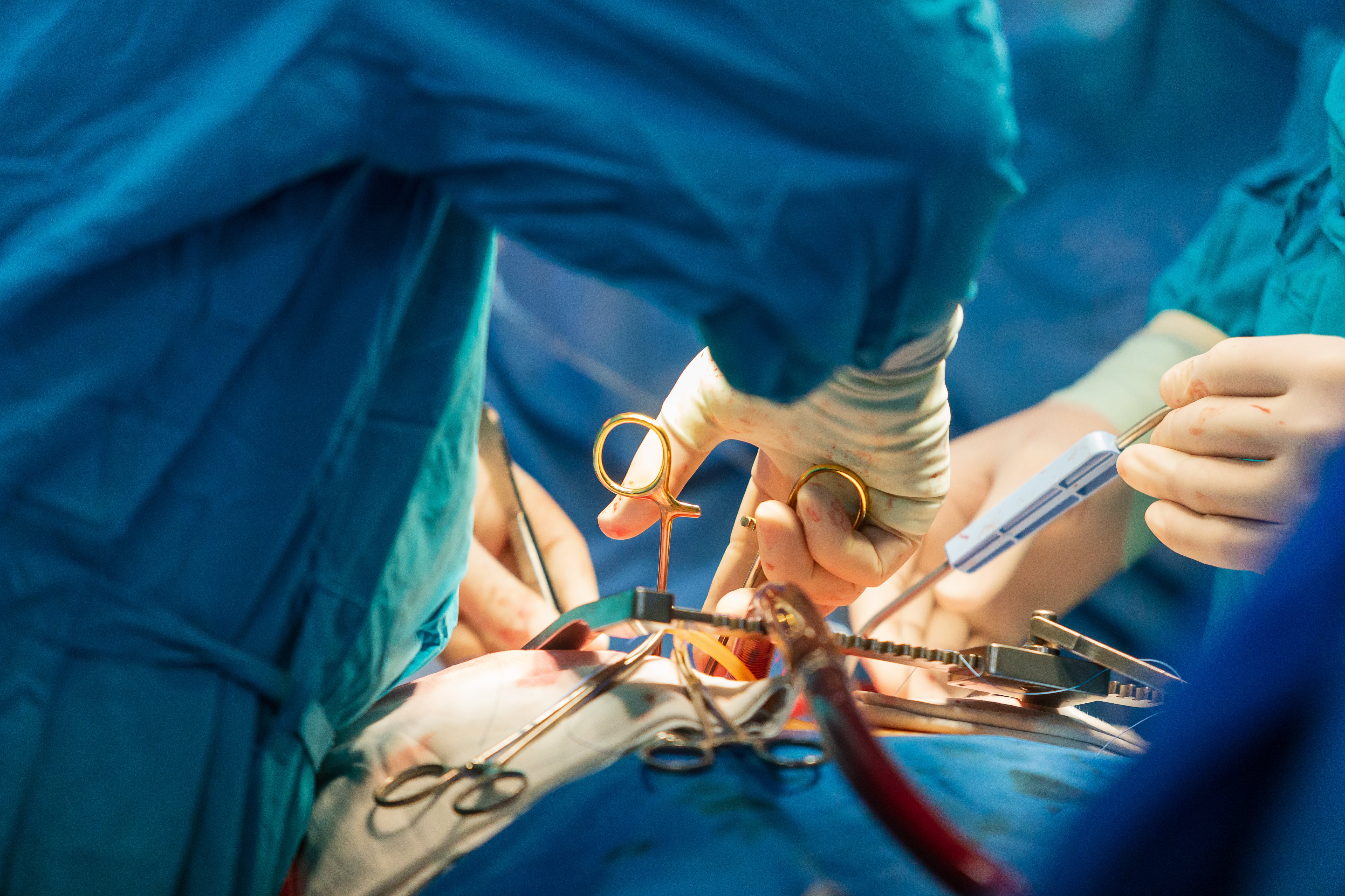 Cardiac surgery. Heart transplantation. Open heart surgery. Surgical instruments. Surgeon at work in the hospital. Open chest. Medical equipment